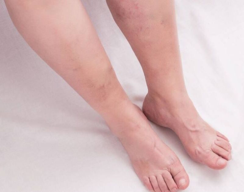 Chronic Venous Insufficiency