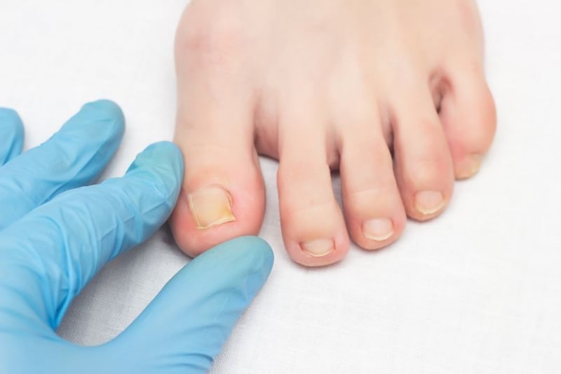 Ingrown Toenail Solutions Publishes Guide to Spotting Ingrown Toenail Warning Signs Before They Escalate