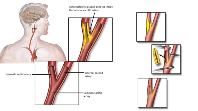 Carotid Artery Disease and Stroke Prevention
