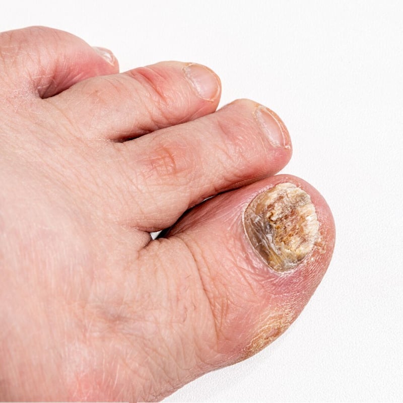 Addressing Nail Fungus - A Crucial Step Towards Healthier Feet