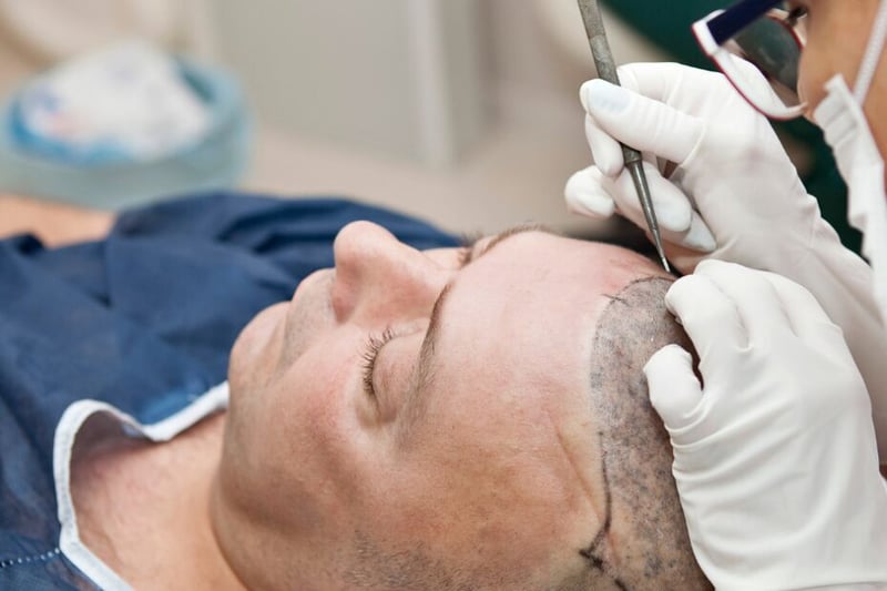 Hair Transplant - A Lasting Solution for Hair Loss