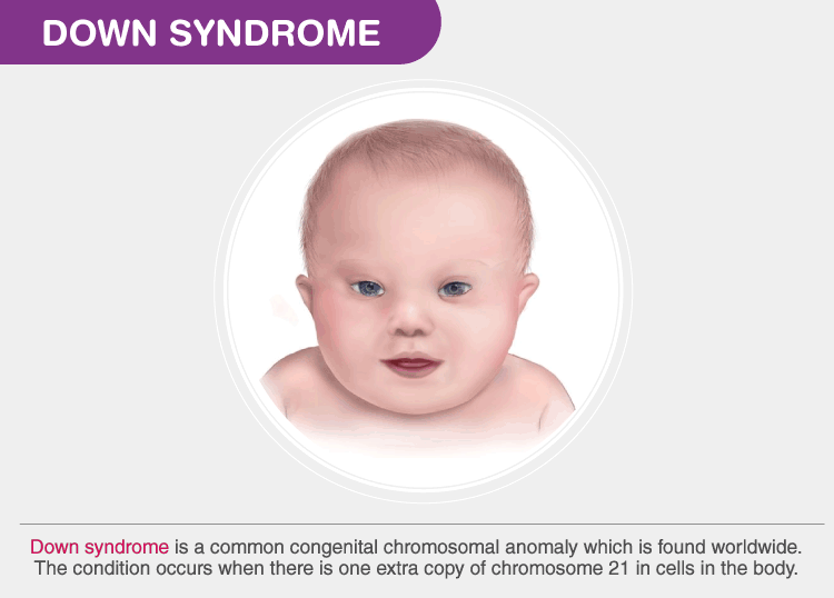 More alike than different -  Developmental care for children with Down Syndrome