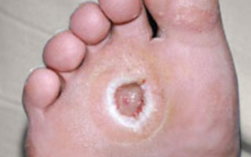 Empowering Patients to Take Control of Diabetic Foot Health