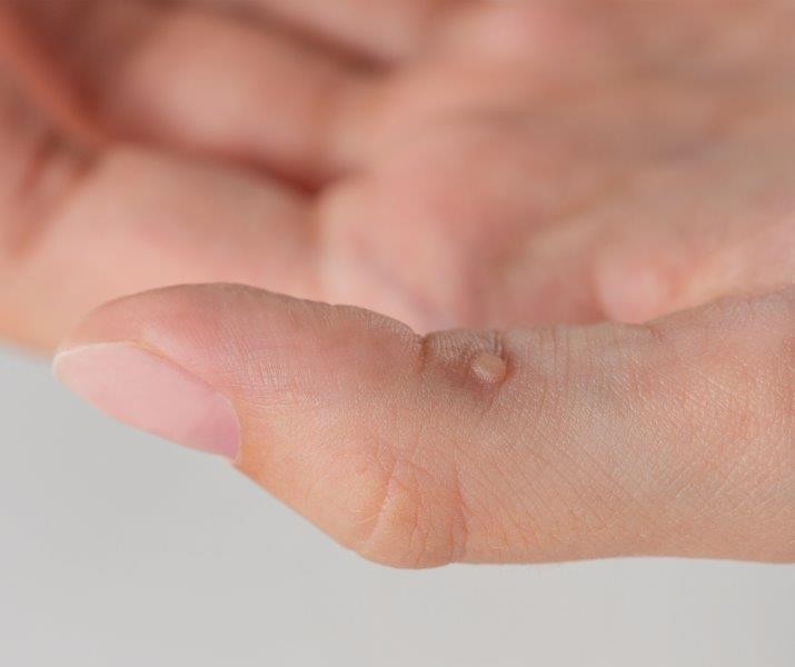 Myths vs Facts - What Causes Warts and How to Treat Them This Summer